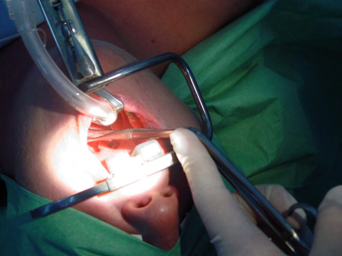 tonsil-surgery